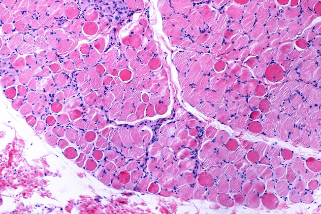 Slide of cells with Duchenne/ Becker Muscular Dystrophy